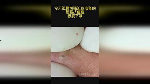 强迫症挤粉刺视频